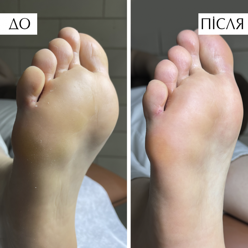 PedicureFoam / Пінка для розм’якшення ороговілої шкіри на стопах ПедикюрФоам PNB, 150 мл