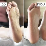 КERA Podoliquid / Кератолітик для видалення мозолів та натоптишів КЕРА Подоліквід PNB, 100 мл